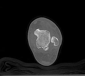 Talus Posterior Process Fracture CT